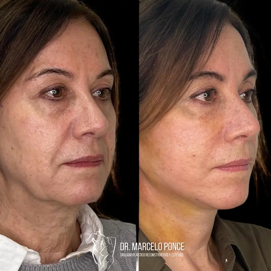 lifting-facial-deep-plane-en-guayaquil
