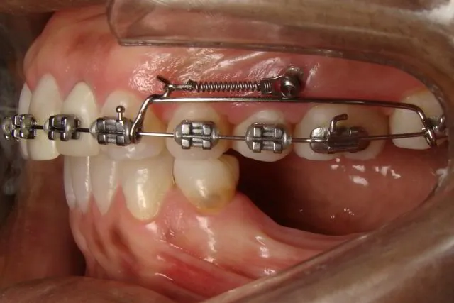 Ortodoncia en Imagen Dental Avanzada