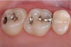 Amalagama Imagen Dental Avanzada Atizapan