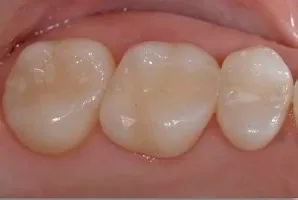 Resina Imagen Dental Avanzada Atizapan
