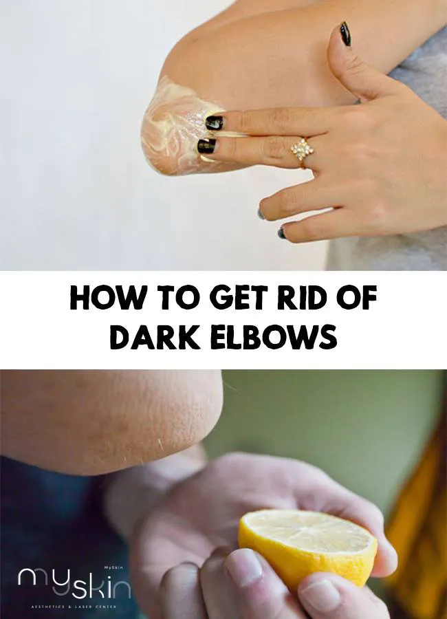 How to get rid of Dark Elbows at My Skin Lahore