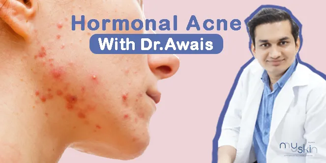 Hormonal Acne: How to treat?
