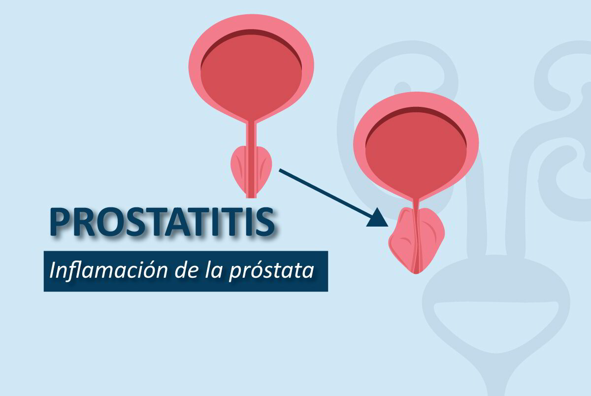 Prostatitis Inflamación de la glándula prostática