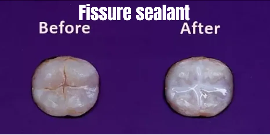Fissure sealant (before & after) by Avant dental surgery