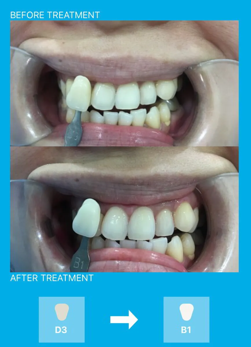 Avant dental surgery- Teeth whitening