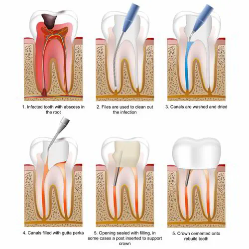 Endodontics Avant Dental Surgery Treatment