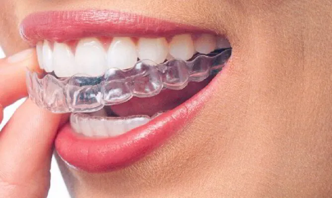 Invisible Braces / Clear Aligner