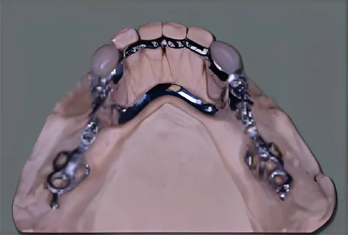 Chrome castings on teeth