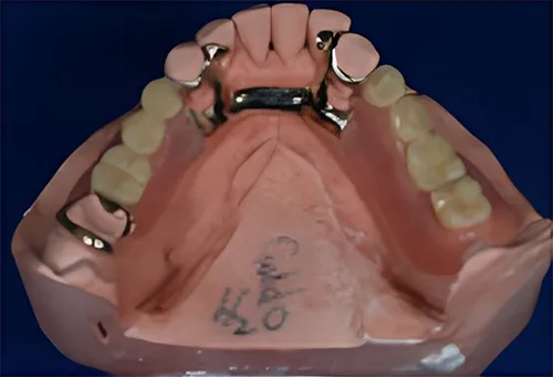 Gold Castings on teeth