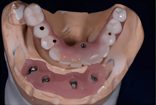 Premium Fixed Implant Dentures