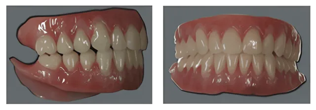 Gum Tinting denture Teeth