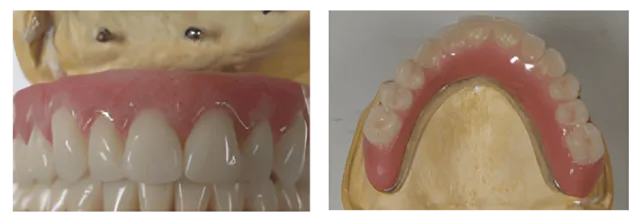 Special Mini Implants Dentures