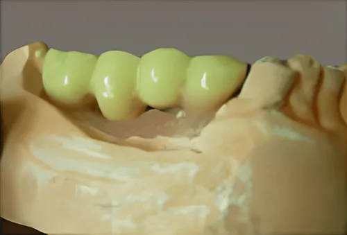 Temporary Implants Dentures