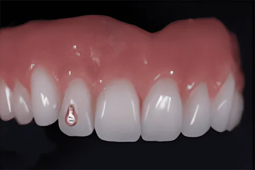 Jewellery in Denture on tooth