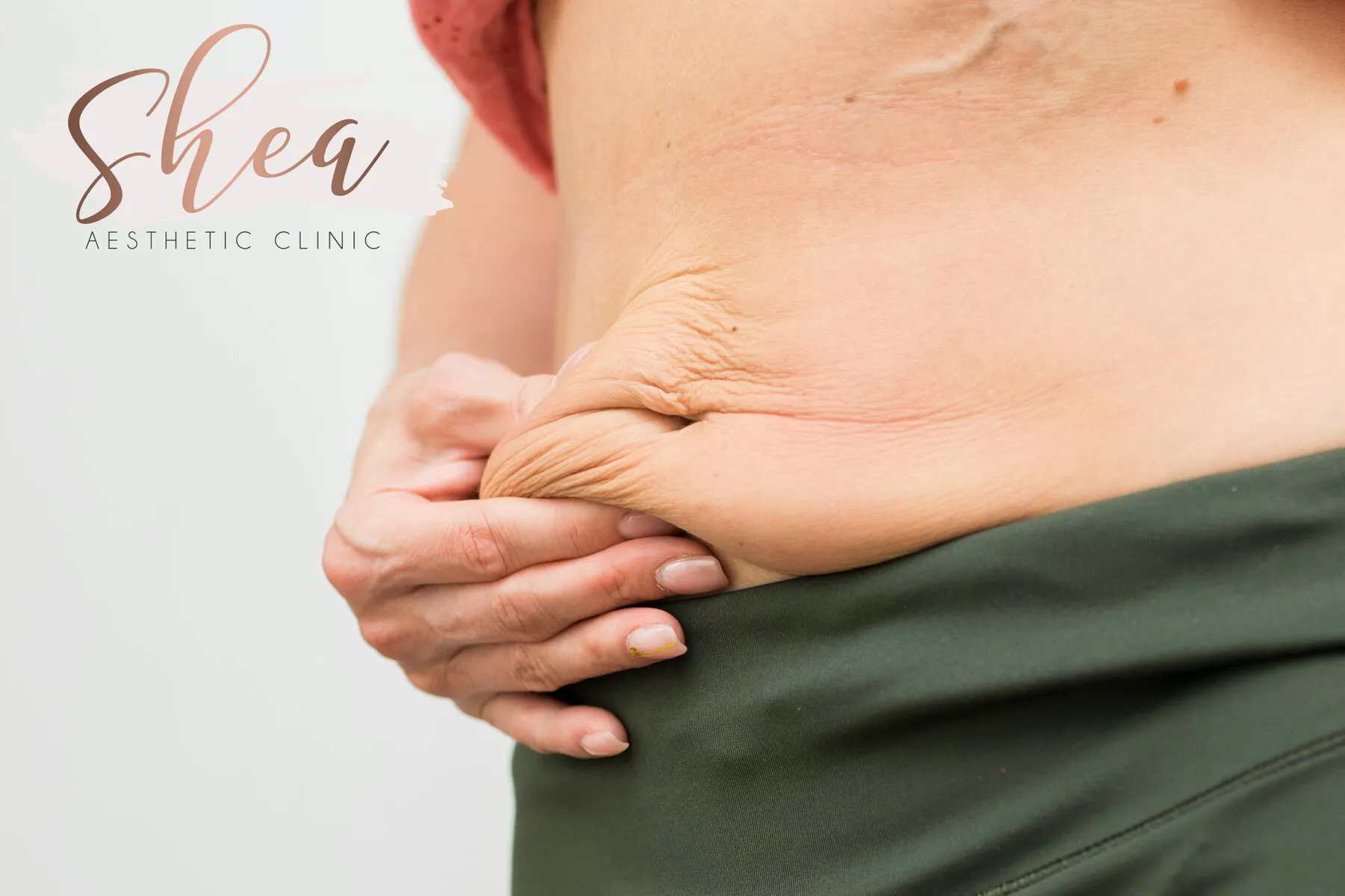 Skin Tightening Treatments for Loose Skin After Weight Loss with