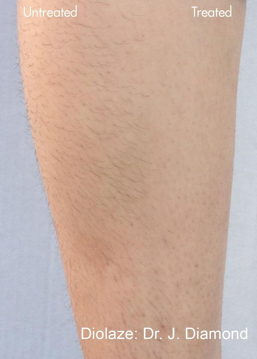 how much is laser hair removal for both legs