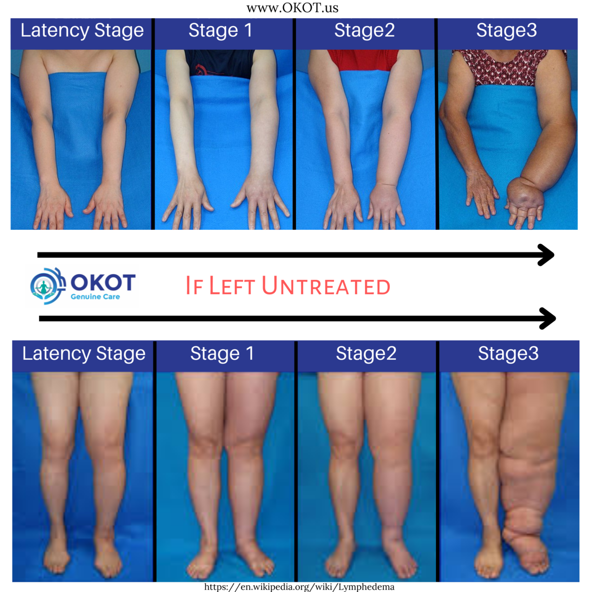 new research on lymphedema