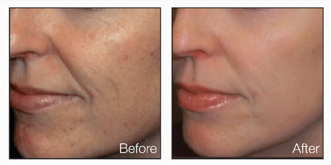 Laser Skin Tightening Before And After