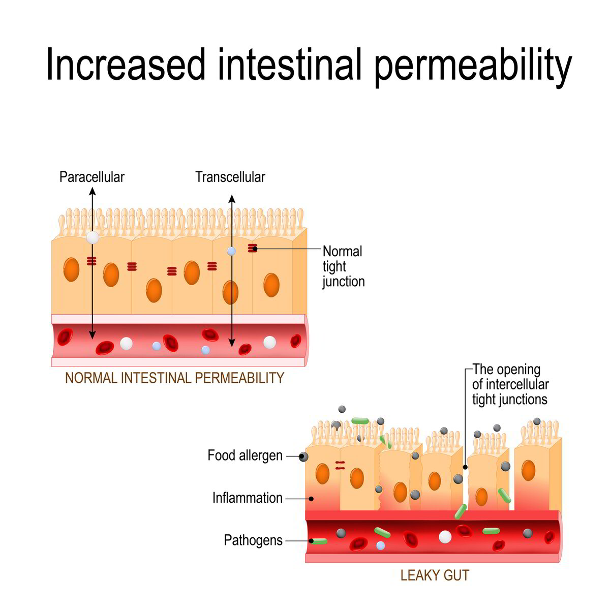 What is "leaky gut" (intestinal permeability)? And how do you fix it? What is "leaky gut" (intestinal permeability)? And how do you fix it?