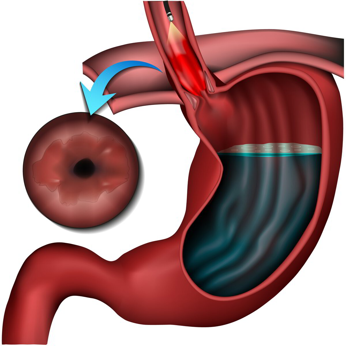bpc 157 barrett's esophagus Oesophago-gastric Surgery Team BPC-157 for GERD: Healing Esophagus