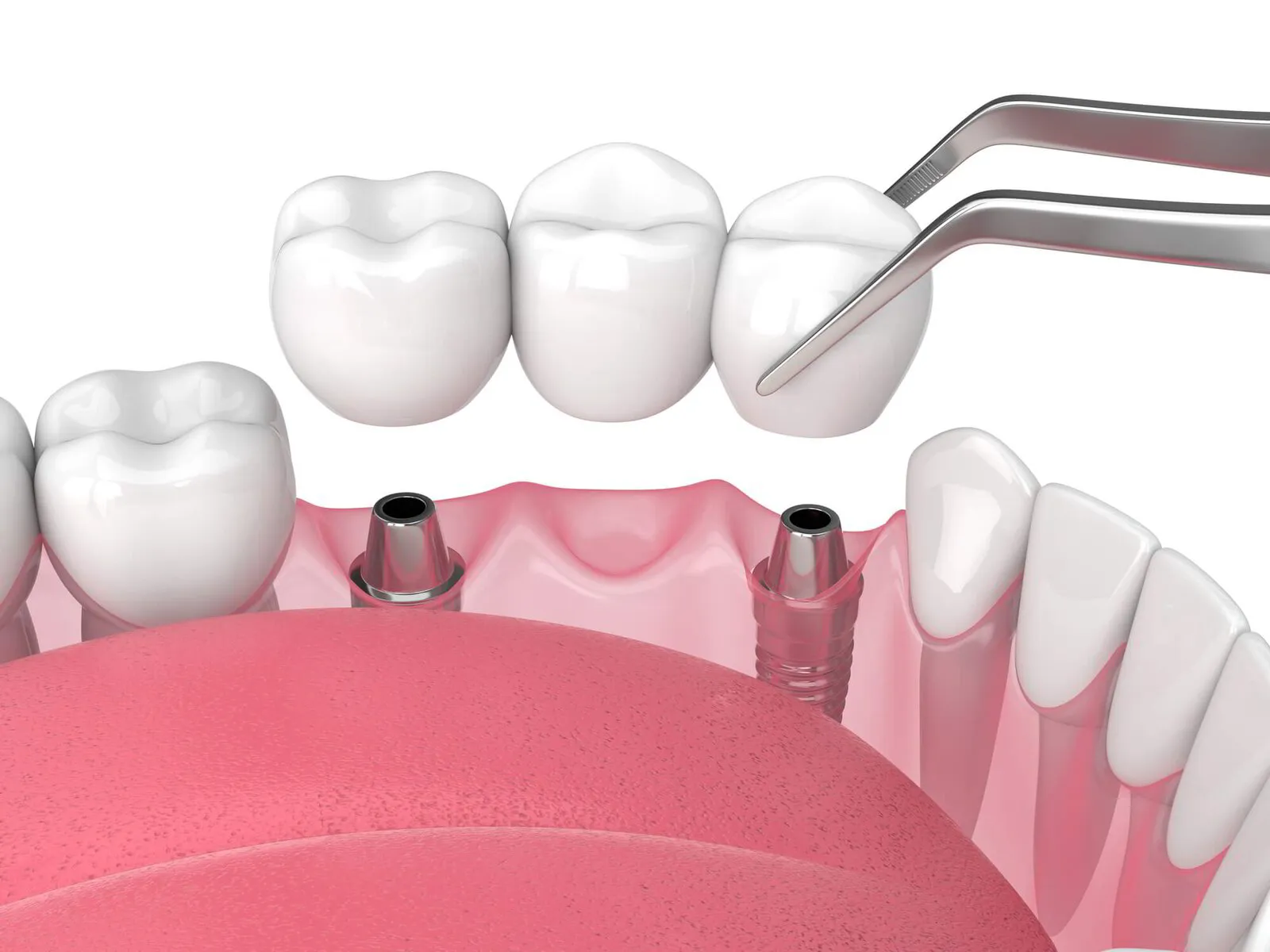 Restoring Your Bite: The Functional Benefits of Dental Bridges