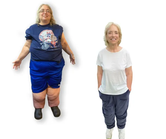 Lipoedema and lymphoedema large heavy legs with cellulite appearance