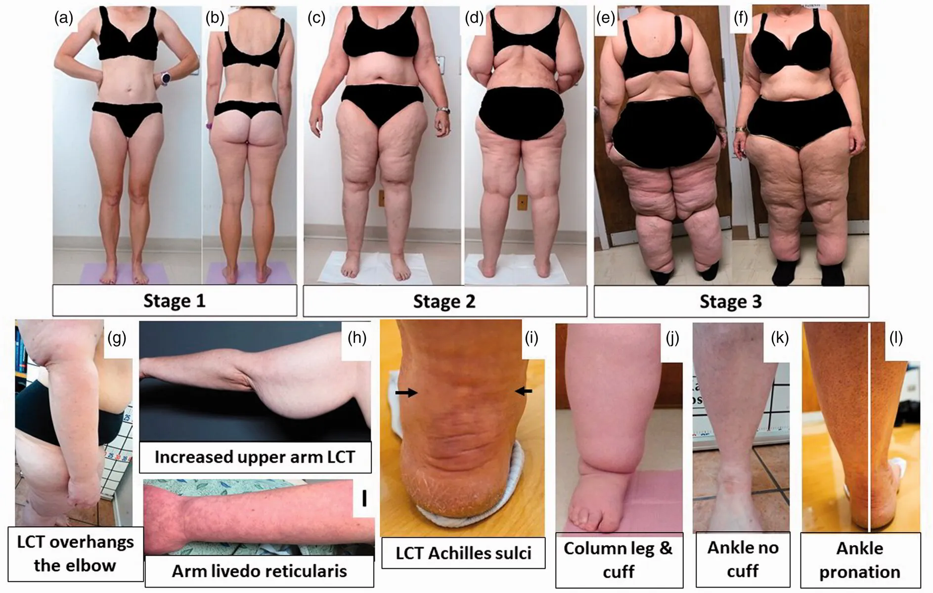 Different stages, signs and symptoms of lipoedema and secondary lymphoedema