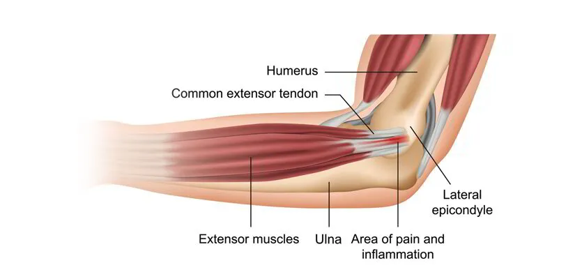 Tennis Elbow that annoying elbow pain