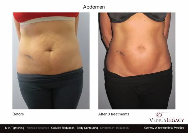 Body Contouring by Venus Versa™ Package