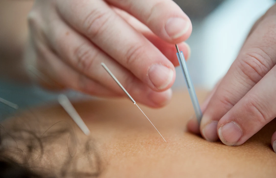 Dry Needling vs. Acupuncture: Understanding the Key Differences