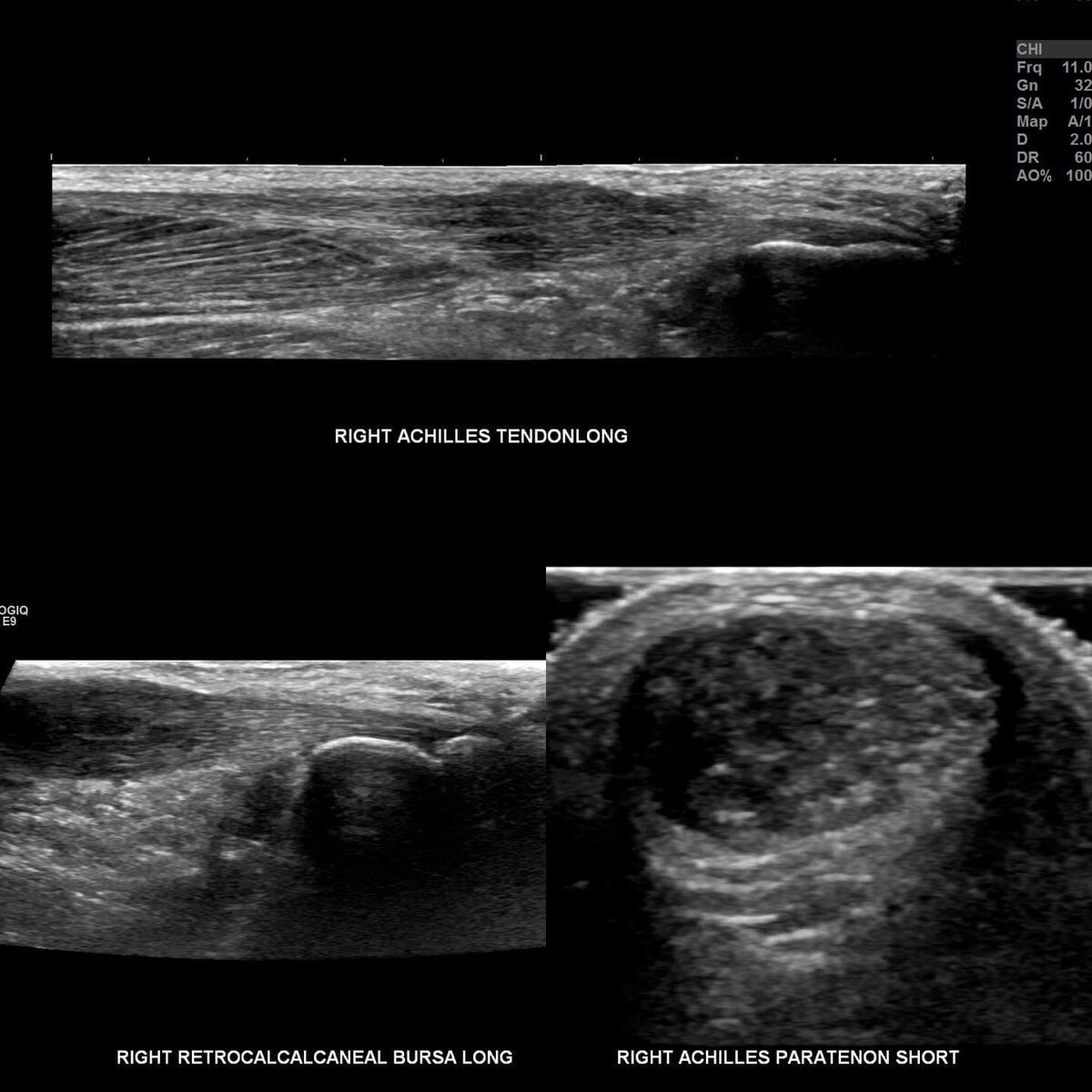 Tendonosis vs. Tendinitis