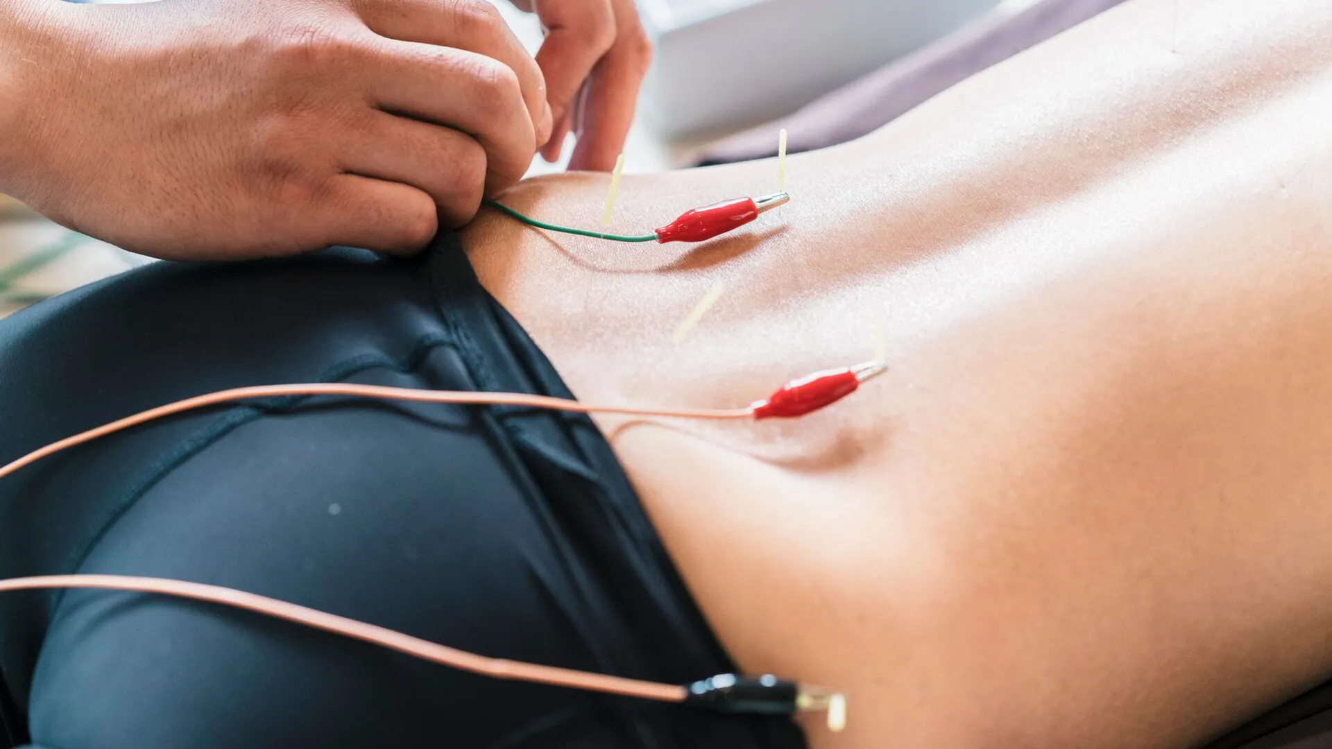 Electroacupuncture: Uses, Process, Evidence, Side Effects, and Safety