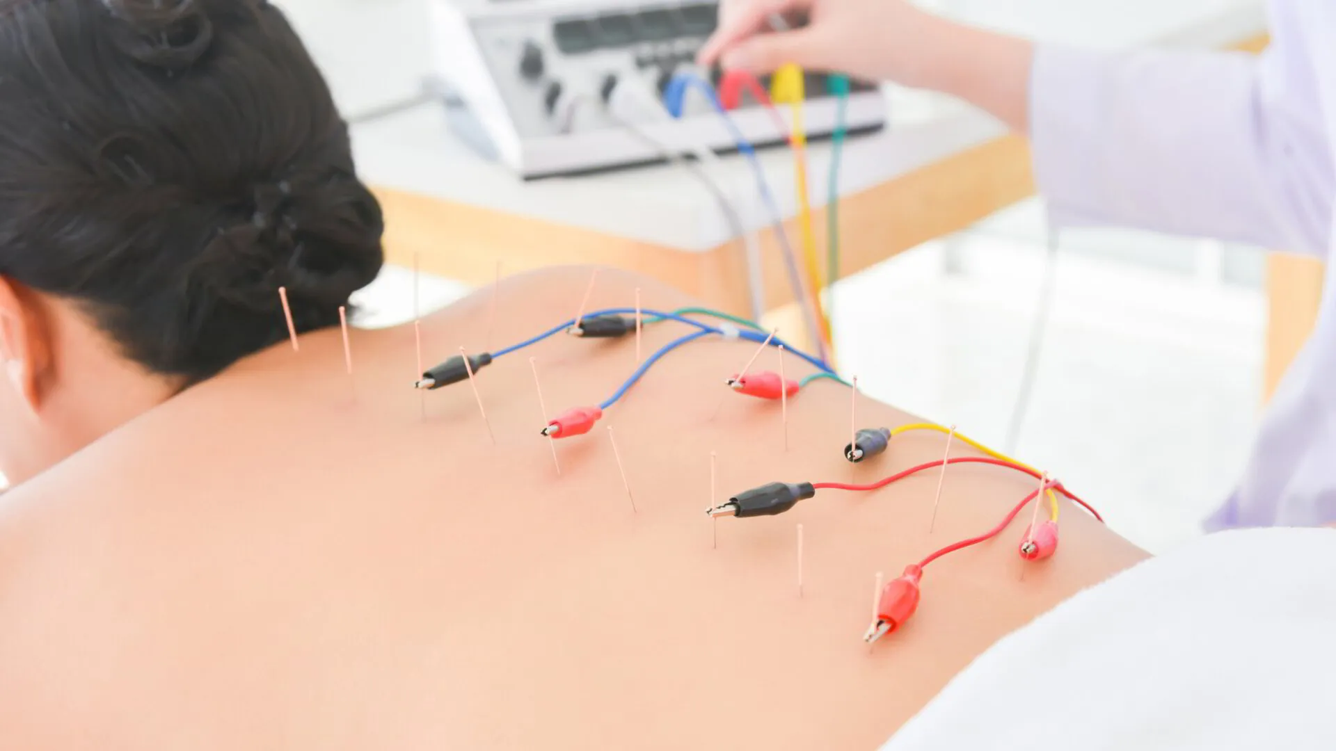 Electroacupuncture: Uses, Process, Evidence, Side Effects, and Safety