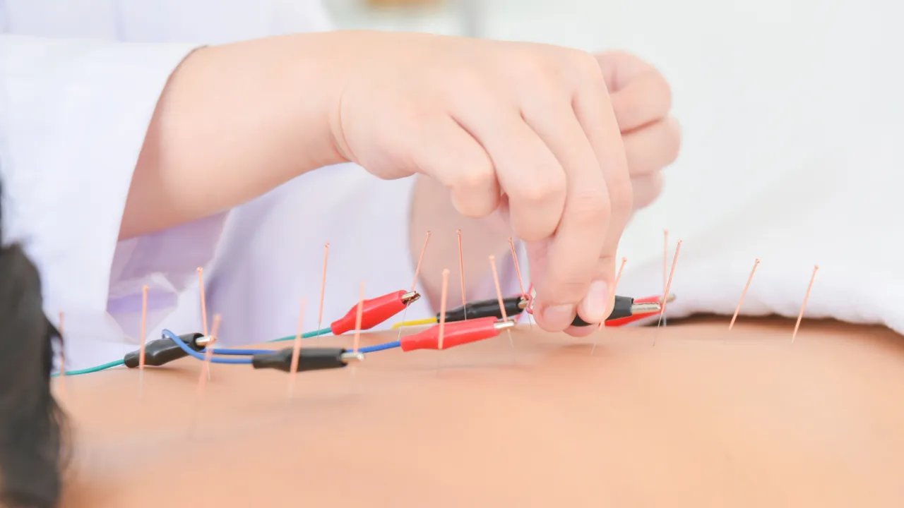 Electroacupuncture: Uses, Process, Evidence, Side Effects, and Safety