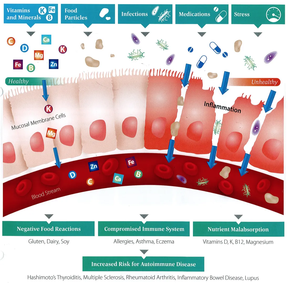 what-is-leaky-gut