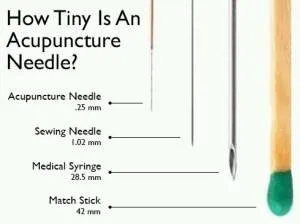 does acupuncture hurt?