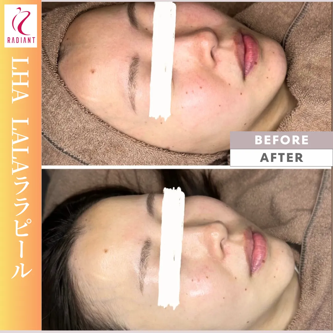 LHA LALAララピール3回分 