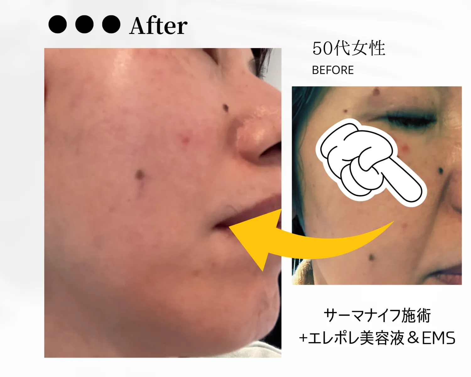 驚きの結果！50代からのたるみ・ほうれい線対策で若返りを実現」
