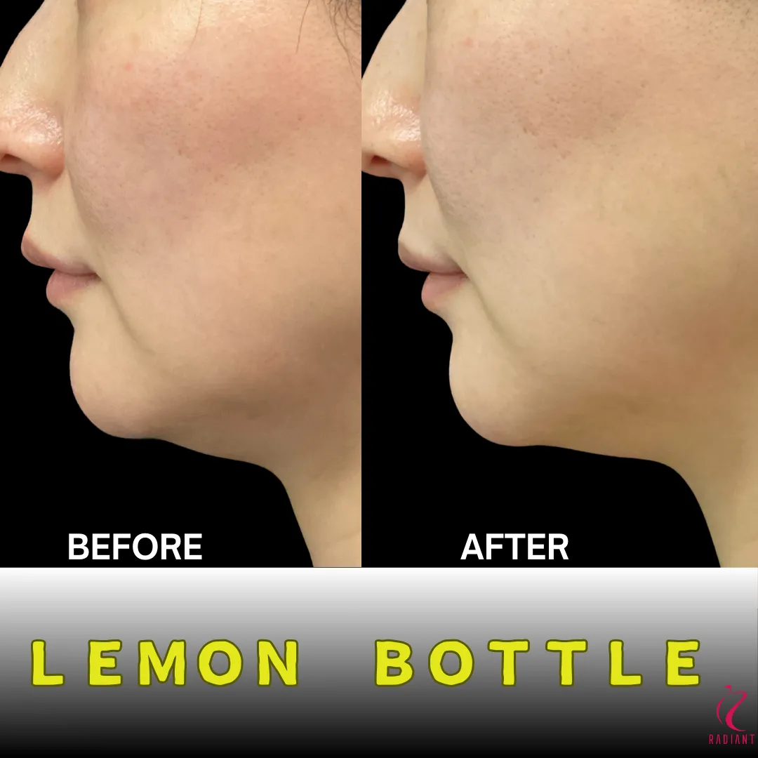レモンボトル脂肪溶解　　 LEMONBOTTLE ～レモンボトル～美容大国韓国で話題の脂肪溶解 - 部分