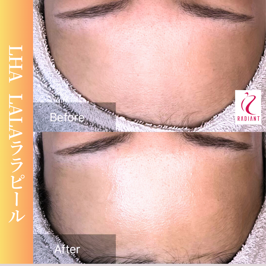 ララピール | ARTE SKIN CLINIC（アルテスキンクリニック）【公式】
