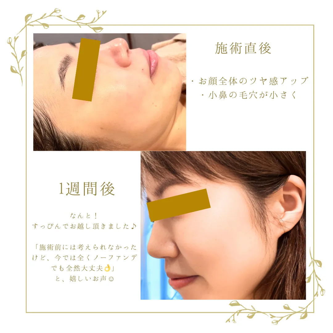 ララピール ララピールの施術直後に気をつけていただくことがあります