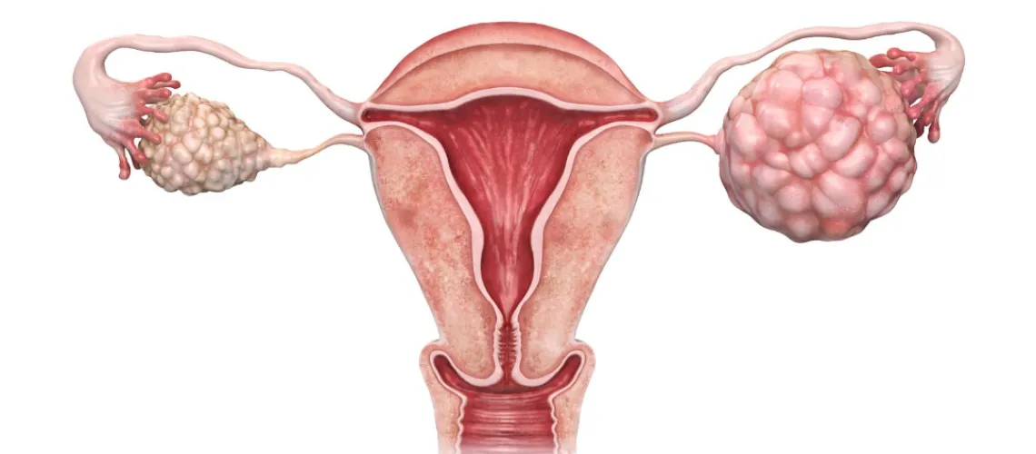 What do the cysts on my ovaries actually mean?