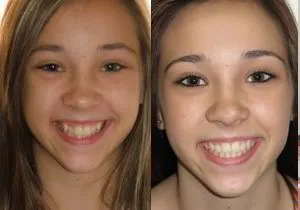 Before and After quality orthodontic treatment, mckinney orthodontics