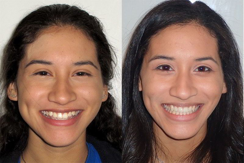 Braces - Before And After Gallery 