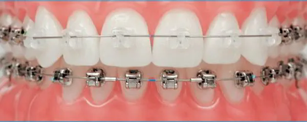 Virtually Invisible Damon&reg; CLEAR™ Braces from Dr. Buchanan
