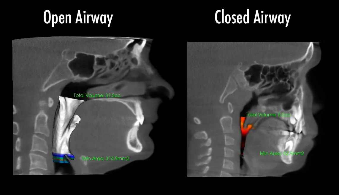 Your Airway and Health 