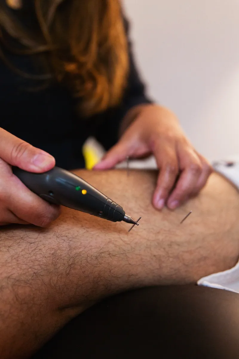 Acupuncture | The Movement Lab