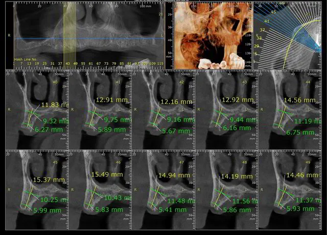 Computer tomograf dentar necesar pentru implant dentar