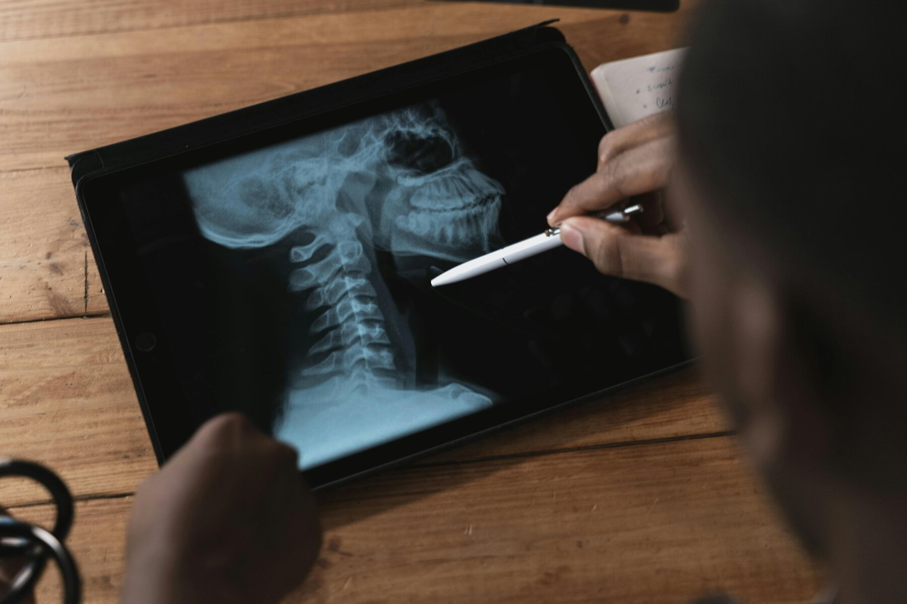 Understanding Subluxation | Chiropractic Healing Center Kansas City