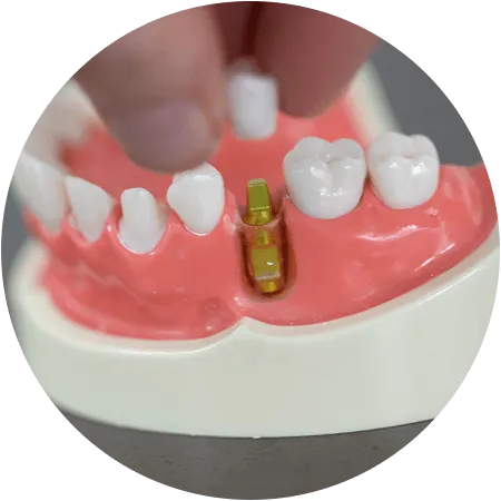 Model showing dental implant